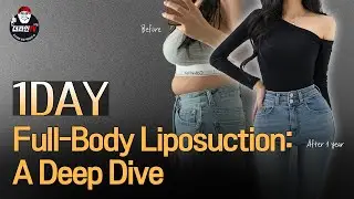 Full Body Liposuction #kbeauty #thelineclinic #liposuctionrevision #liposuction