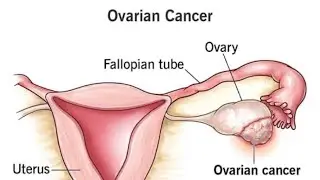 Malignant conditions of ovary last part, #gynaecology #gynae #tenteachers #ovarycancer
