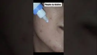 ACSOLVE LOTION 🧴 SE PIMPLES KA KHATMA ||#acsolvelotion#shortvideo #pimplefreeskin #pimple