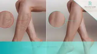 Say Goodbye to Varicose Veins and Spider Veins at Relevium Pain & Vein