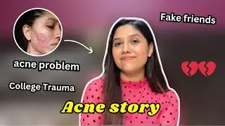 My acne story : Pimples acne problem, fake friends, college life / must watch ..