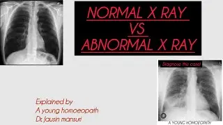 NORMAL CHEST X RAY Vs ABNORMAL CHEST X RAY PART 1 / A YOUNG HOMOEOPATH
