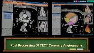 Post Processing of CECT Coronary Angiography| By Anis Qureshi