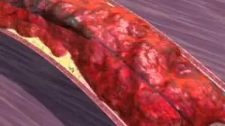Treatment of Myocardial Infarction
