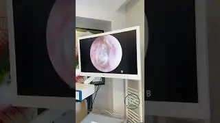 Kulağında tıkanıklık hissi olan hastamızı muayene ettik. Part1.