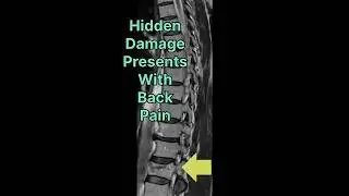 * The Silent Shrink: Why 80% of Spine Fractures Go Unnoticed#Osteoporosis  #BackPain