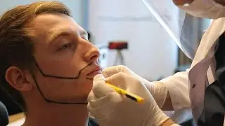 Beard Transplant | Jay's Complete Journey to a Full Beard