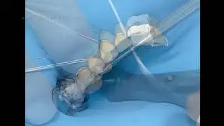 David Gerdolle -  Onlays/Veneers Adhesive Cementation with Warmed Composite   #addent