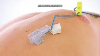 PPS Nano Safety Huber Needle - One-handed safety needle activation