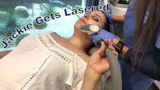 Jackie Gets Lasered! Sublative Laser Treatment for Acne Scars