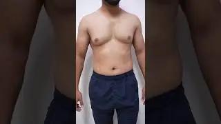 Gynecomastia Surgery before & After #shorts #ytshorts