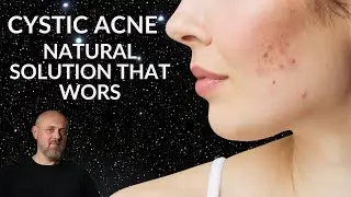 Cystic Acne: Tongue Tells it All. TCM Tongue Diagnosis