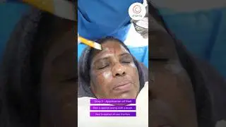 Chemical Peel For Melasma - Charma Clinic #shorts