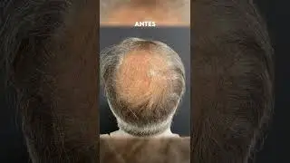 Progresso de um paciente ap&oacute;s o tratamento com MMP capilar