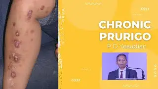 Хроническое пруриго/Узловое пруриго/Узловое пруриго &ndash; всесторонний обзор, включая лечение
