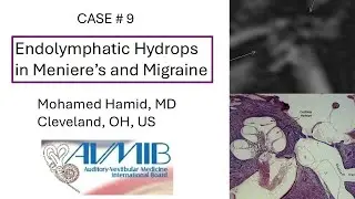 Case 9   Hydrops in Meniere's and Migraine