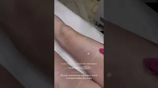 Подготовка к лазерной эпиляции на александритовом лазере Candela GentleLase pro-U