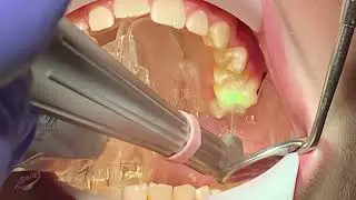 Solea  Laser Dentistry