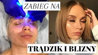 JAK POZBYĆ SIĘ TRĄDZIKU I ZMIAN POTRĄDZIKOWYCH