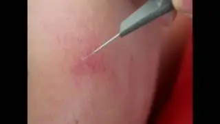 Spider Vein Removal RBS100 Video
