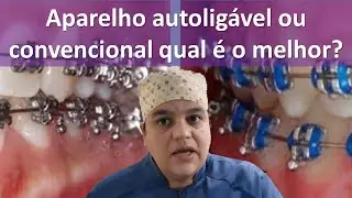 Qual é melhor, o aparelho autoligado ou convencional? | Dra Bianca Rosa | Clínica Bianca Rosa