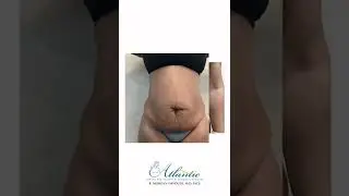 Tummy Tuck Surgery Atlanta Georgia | Abdominoplasty