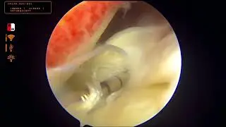 Meniscus repair video