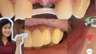FIBER REINFORCED COMPOSITE BRIDGE dental clinic in kuwait