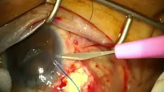 07092025 GDD Revision (Ahmed Clearpath 350) Addition of Ligature Suture and Cutting of Tube