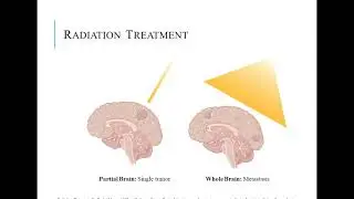 Understanding and ameliorating radiation-induced damage to oligodendrocytes