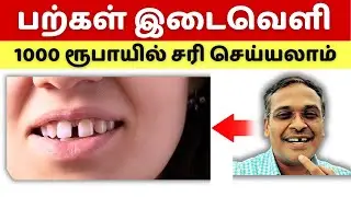 This is a simple treatment to fix the gap between teeth!! tamil health tips dr karthikeyan teeth gap