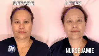 Carbon Facial on The Doctors with Nurse Jamie