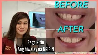 hiwa hiwalay na ngipin pagdikitin ( diastema closure using veneers)