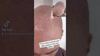 First Session Results: What to expect from Scalp MicroPigmentation #smp