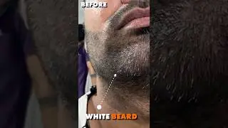 White Beard Removal Treatment By Fue Method | White Beard Permanent Solution | #whitebeard #fue