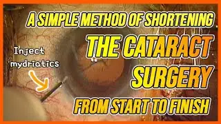 A simple method of making mydriatics spread faster during cataract surgery (with clova dubbing)