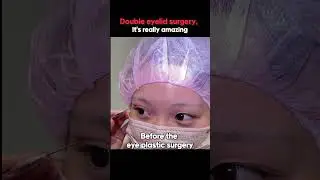 Real review! Before and after eye plastic surgery 👀
