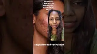 Acne regimens fail when actives are overused or underused.#Treatacne#skinbarrier#hyperpigmentation.