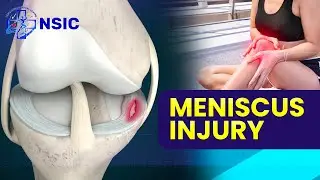 Meniscus Tear Explained: Causes, Symptoms & Treatment | Knee Injury Relief