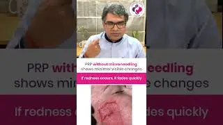 PRP Treatment for Acne Scars | Post-Treatment Care & Possible Side Effects | Dr. Sunil Kothiwala