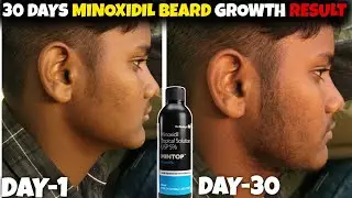 सिर्फ़ एक महीना में ही दाढ़ी आ गई | Mintop minoxidil 5 beard growth results | minoxidil beard growth