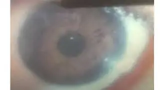 Right eye reading - iridology and detoxification