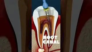 Root Canal Procedure 3D Animation & Tooth Abscess #short #rootcanal