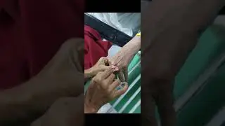 BD Nexiva IV catheter insertion Tips Technique Tricks