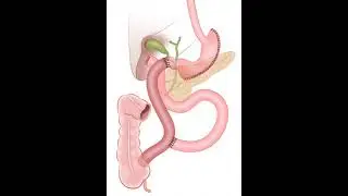 Podcast-25. EGD-Duodenal Switch