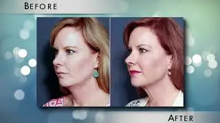 Dr. Smoot | What is Thermi RF Skin Tightening?