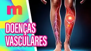 Saiba mais sobre DOENÇAS VASCULARES - Mulheres (15/10/2024)