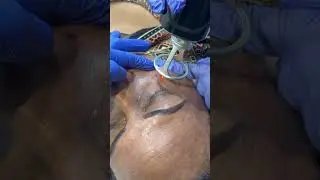 Fractional CO2 Laser Resurfacing Treatment &ndash; for scar reduction  wrinkles fine lines call 8921483140