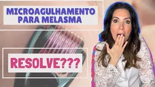 Microagulhamento clareia melasma? #microagulhamento #melasma
