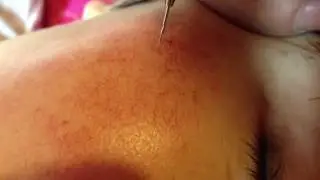 Perfessional Vascular Removal RBS100